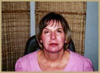 After laser skin resurfacing