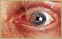Cicatrical pterygium